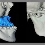 Planeación virtual 3D en cirugía ortognática