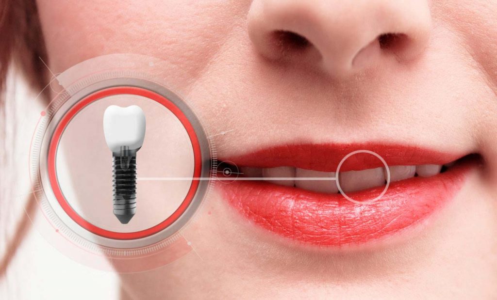 Implantes dentales y sus superficies
