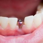 ¿Es posible colocar los dientes inmediatamente tras los implantes?
