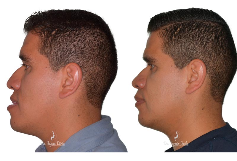 ¿Estás pensando en mejorar tu mentón? Todo comienza con un diagnóstico facial