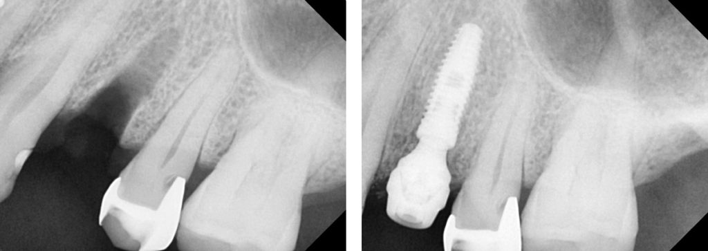 Implante dental - Dra. Yazmín Dávila - Antes y despues