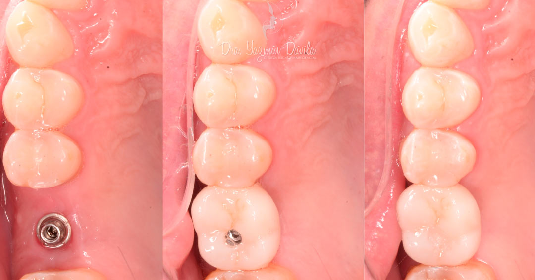 Implante dental – Dra. Yazmín Dávila