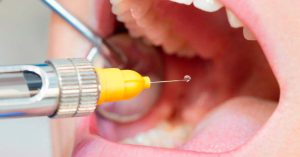 Anestesia local en cirugía maxilofacial