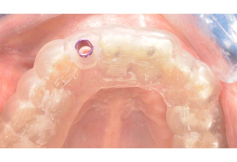 Implante dental despues de perder un diente